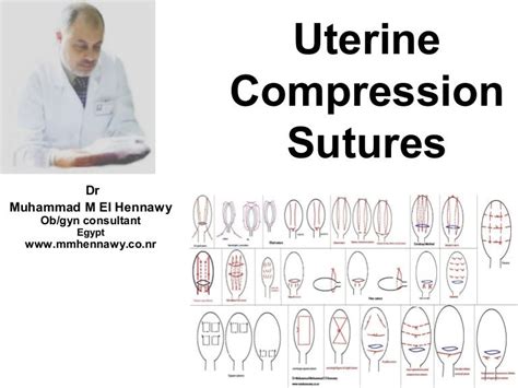 external compression sutures test|Uterine compression sutures for postpartum hemorrhage: an .